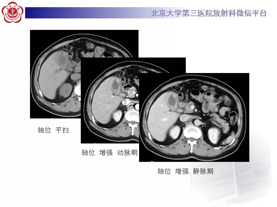 【病例】黄色肉芽肿性胆囊炎1例CT及MR影像诊断