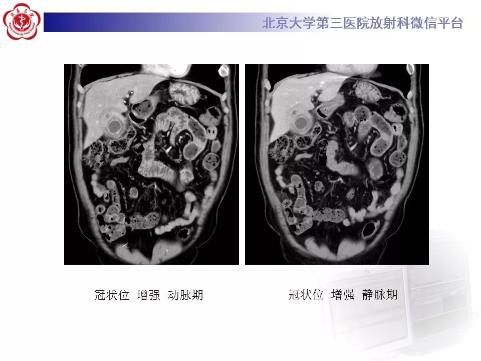 【病例】黄色肉芽肿性胆囊炎1例CT及MR影像诊断