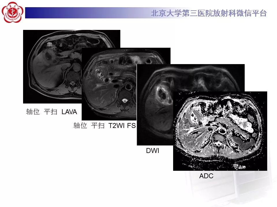 【病例】黄色肉芽肿性胆囊炎1例CT及MR影像诊断