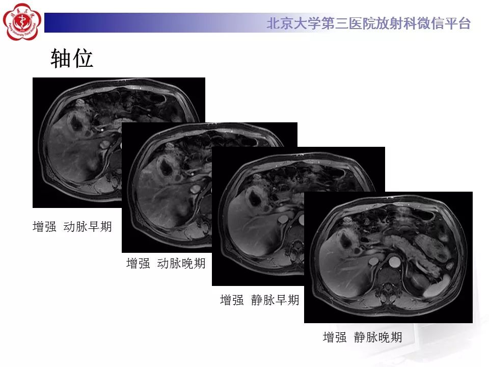 【病例】黄色肉芽肿性胆囊炎1例CT及MR影像诊断