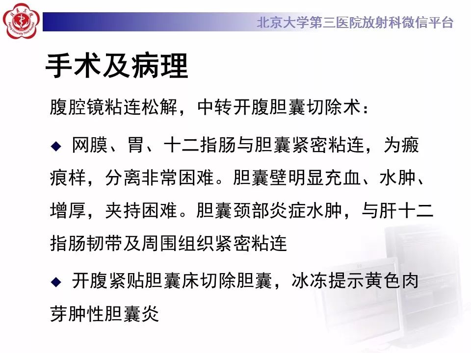 【病例】黄色肉芽肿性胆囊炎1例CT及MR影像诊断