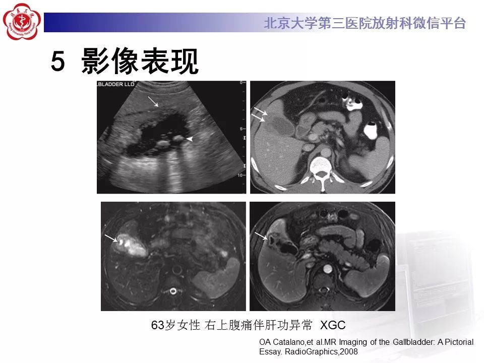 【病例】黄色肉芽肿性胆囊炎1例CT及MR影像诊断