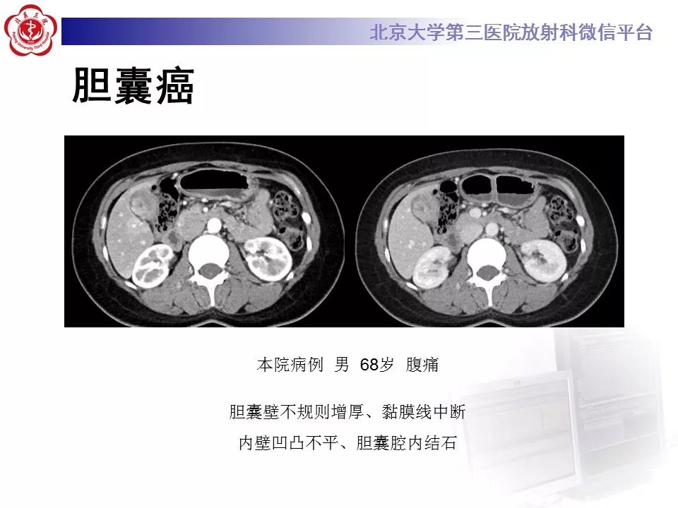 【病例】黄色肉芽肿性胆囊炎1例CT及MR影像诊断