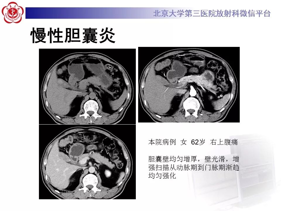 【病例】黄色肉芽肿性胆囊炎1例CT及MR影像诊断