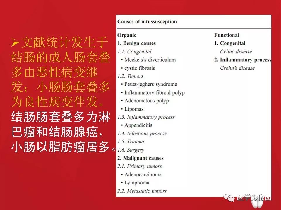 【PPT】肠套叠的CT诊断