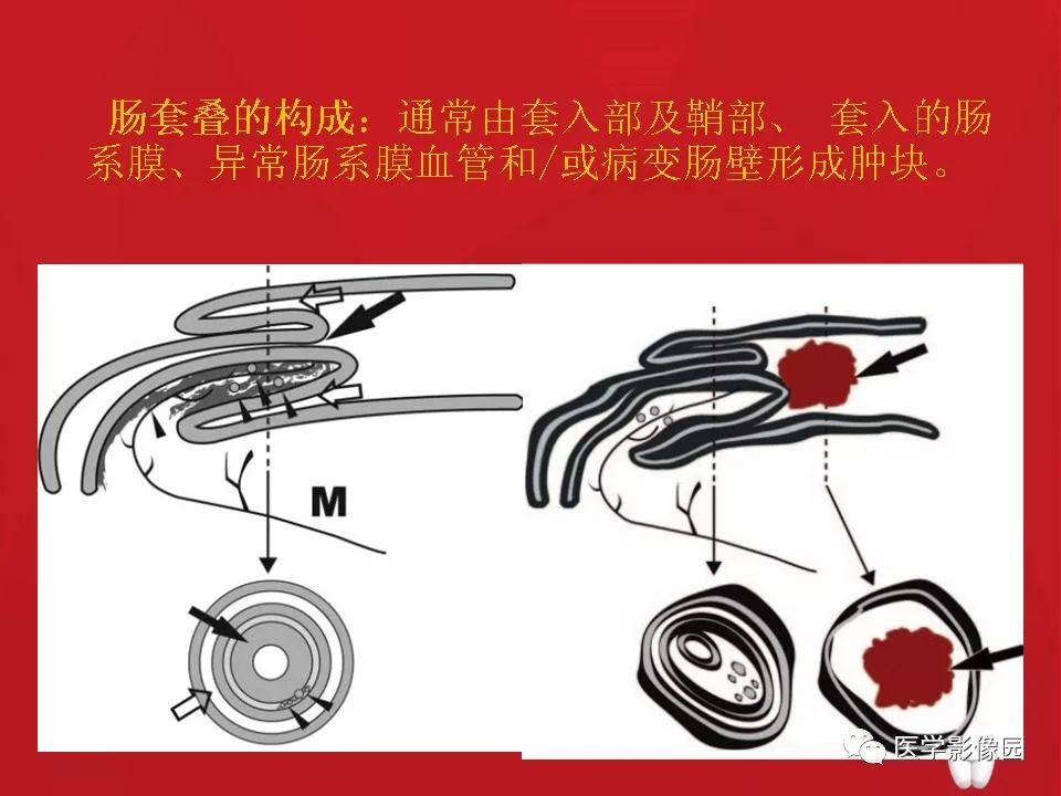 【PPT】肠套叠的CT诊断