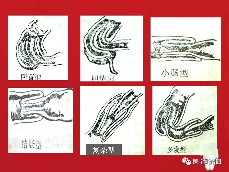 【PPT】肠套叠的CT诊断