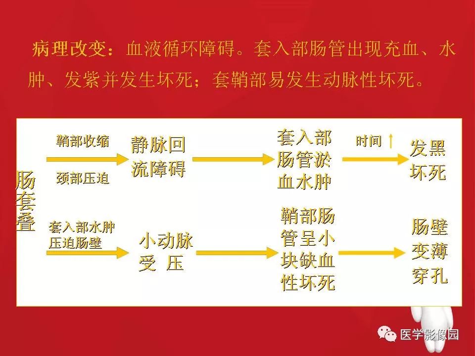 【PPT】肠套叠的CT诊断