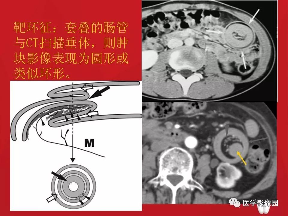 【PPT】肠套叠的CT诊断