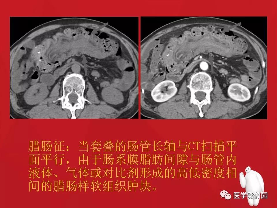 【PPT】肠套叠的CT诊断