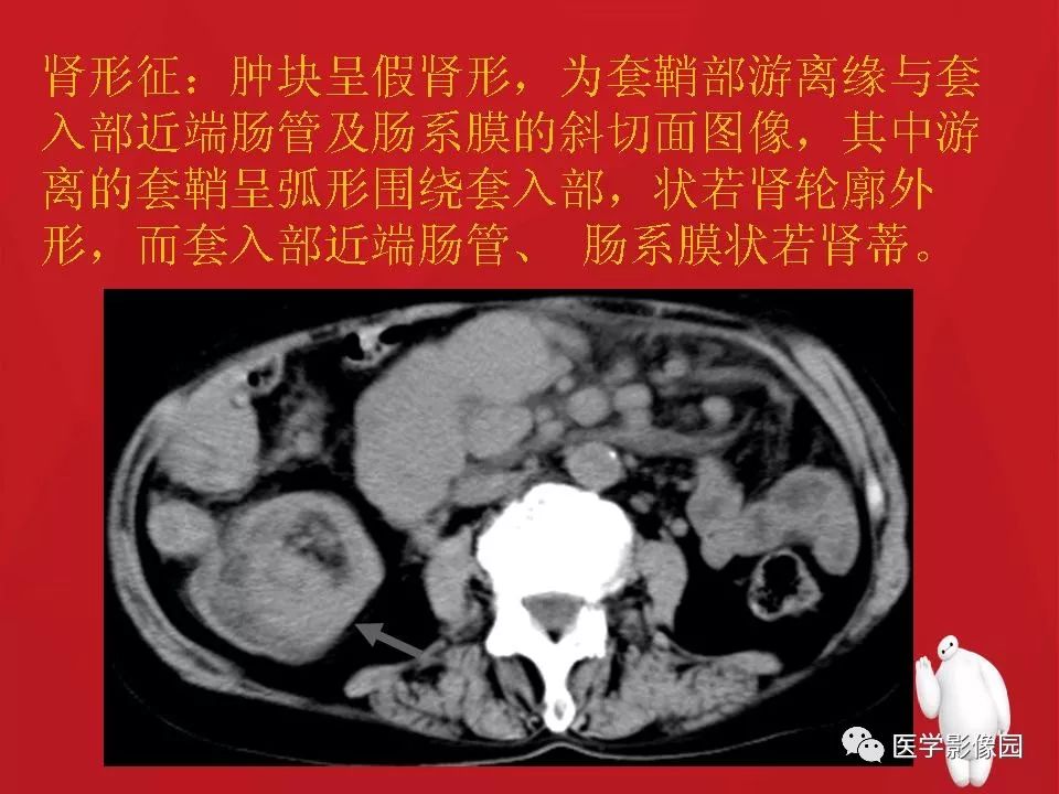 【PPT】肠套叠的CT诊断