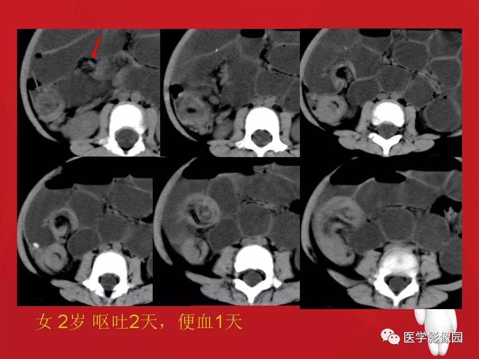 【PPT】肠套叠的CT诊断
