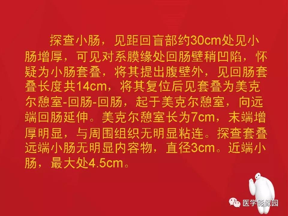 【PPT】肠套叠的CT诊断