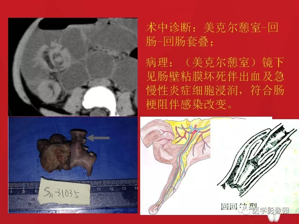 【PPT】肠套叠的CT诊断