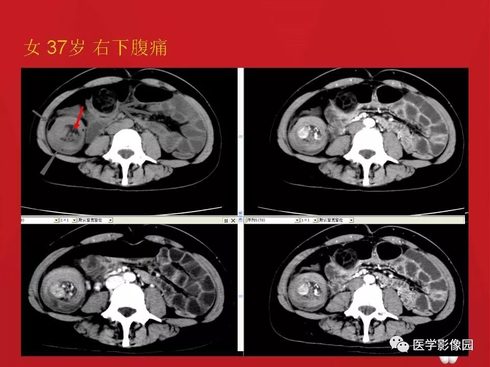 【PPT】肠套叠的CT诊断