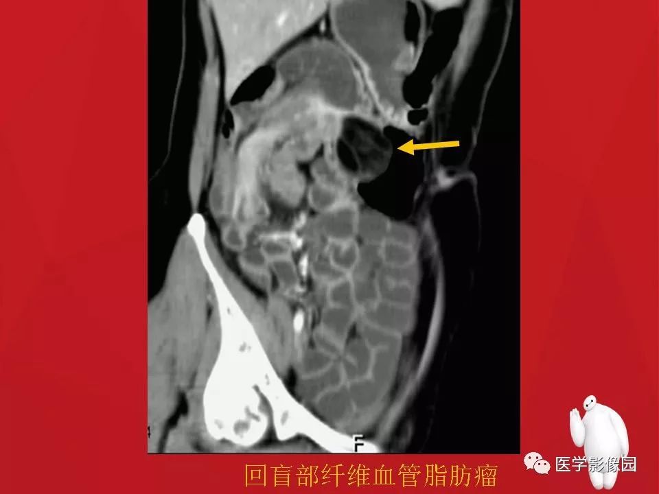 【PPT】肠套叠的CT诊断