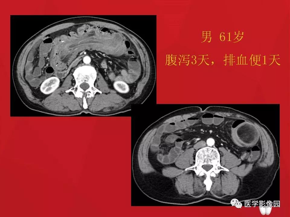 【PPT】肠套叠的CT诊断