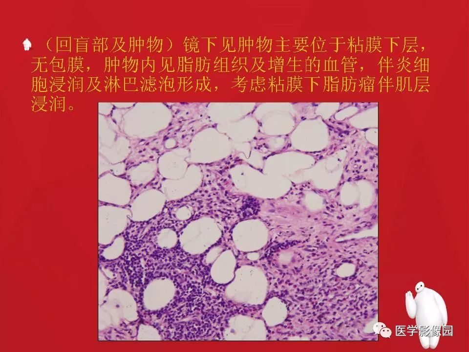 【PPT】肠套叠的CT诊断
