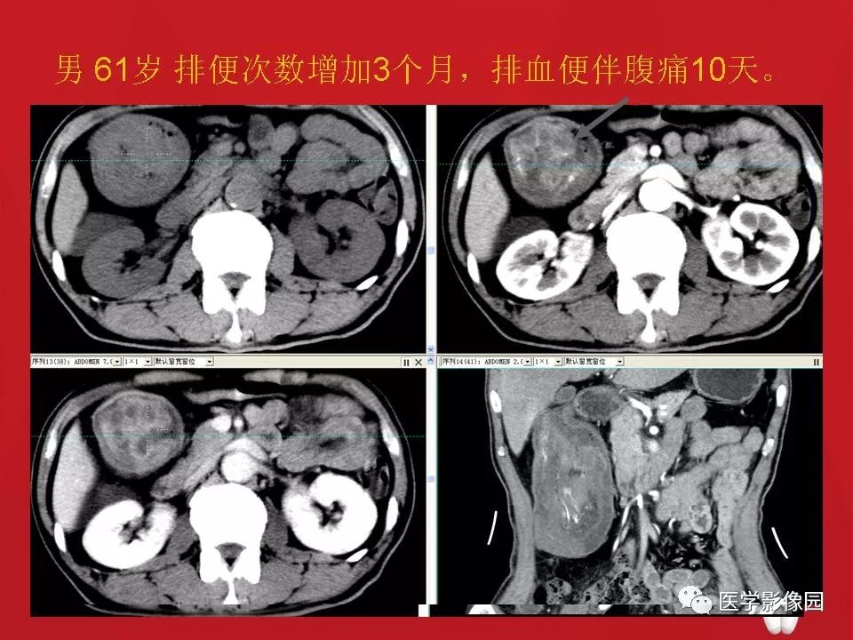 【PPT】肠套叠的CT诊断