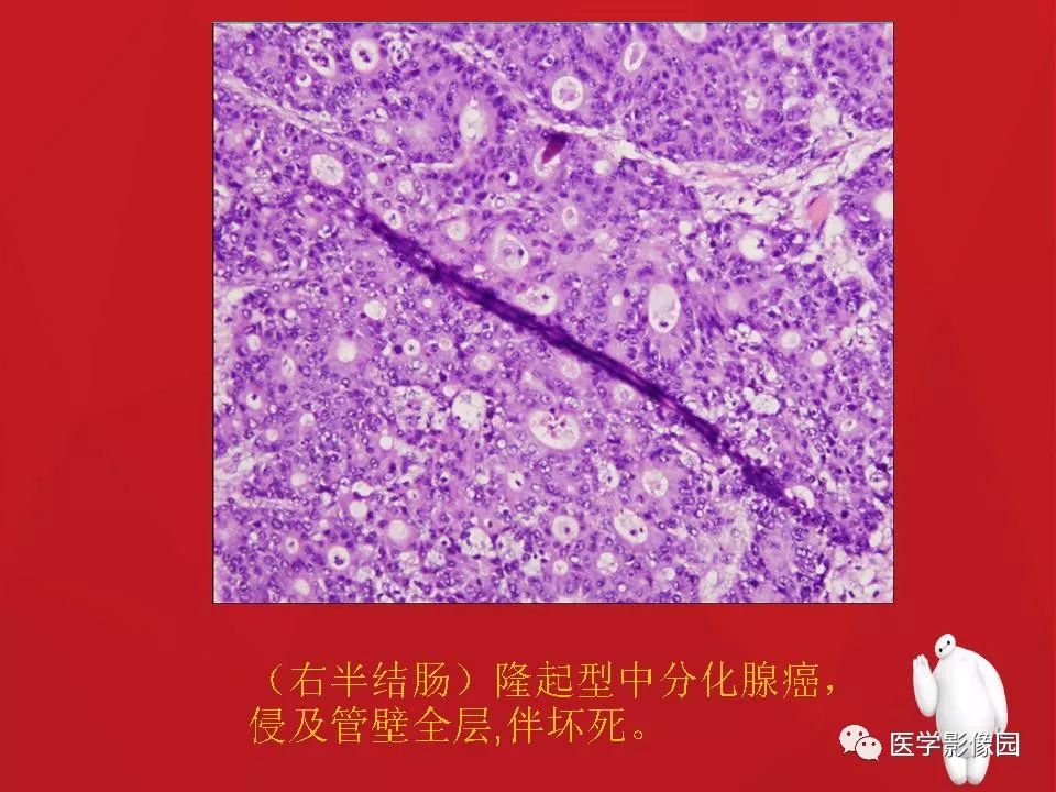 【PPT】肠套叠的CT诊断