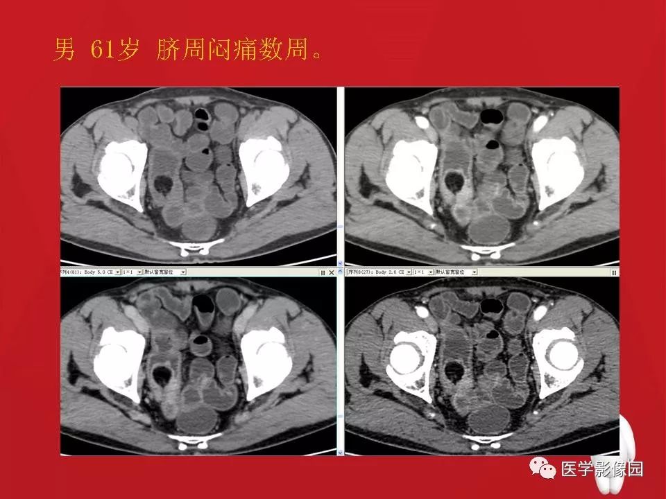 【PPT】肠套叠的CT诊断