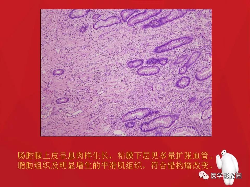 【PPT】肠套叠的CT诊断