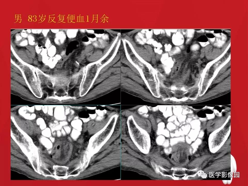 【PPT】肠套叠的CT诊断