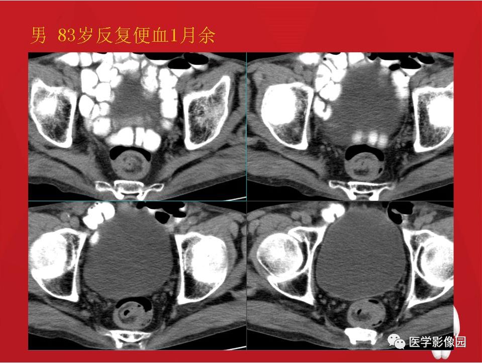 【PPT】肠套叠的CT诊断