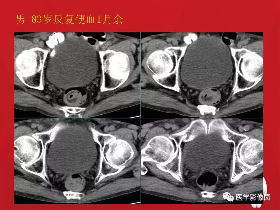 【PPT】肠套叠的CT诊断