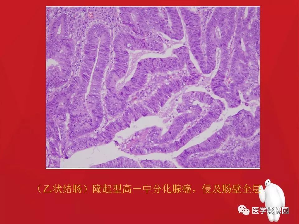 【PPT】肠套叠的CT诊断