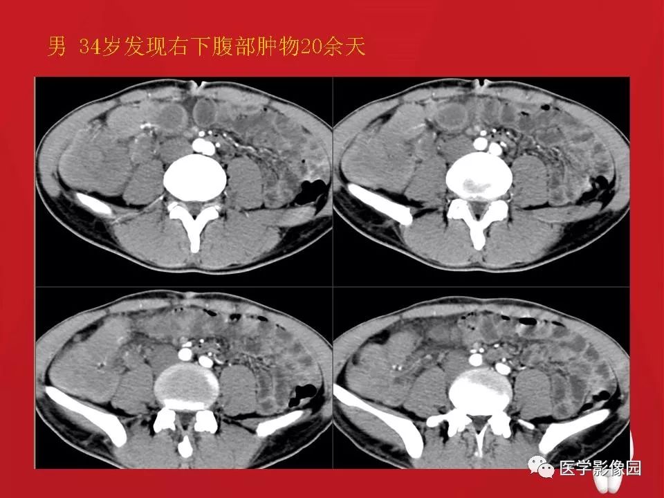 【PPT】肠套叠的CT诊断
