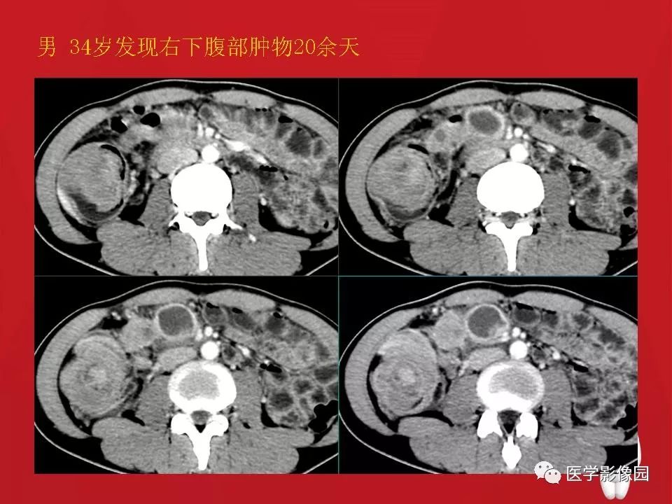 【PPT】肠套叠的CT诊断