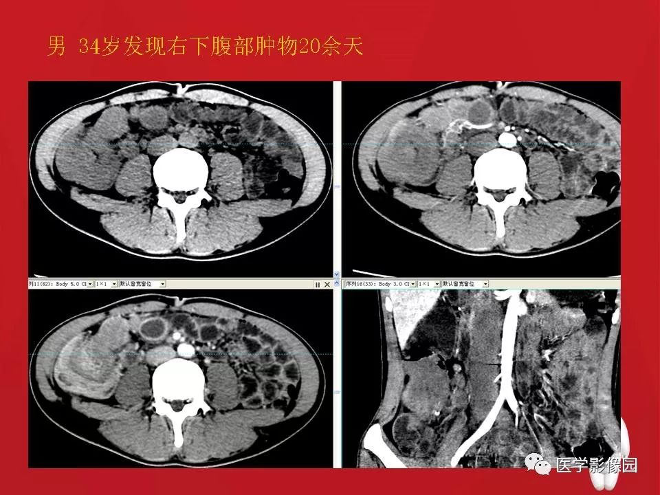【PPT】肠套叠的CT诊断