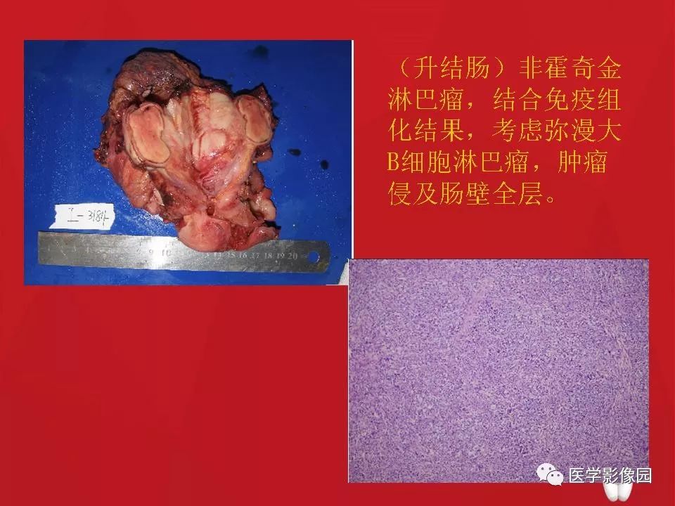 【PPT】肠套叠的CT诊断