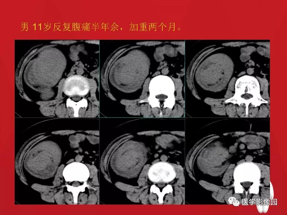 【PPT】肠套叠的CT诊断