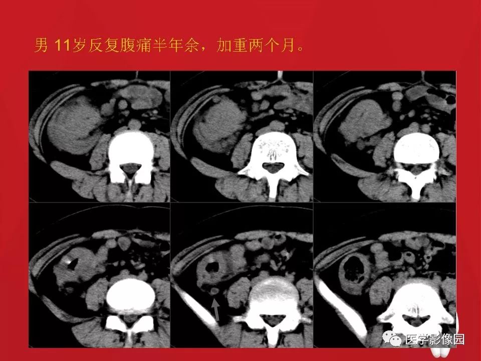 【PPT】肠套叠的CT诊断