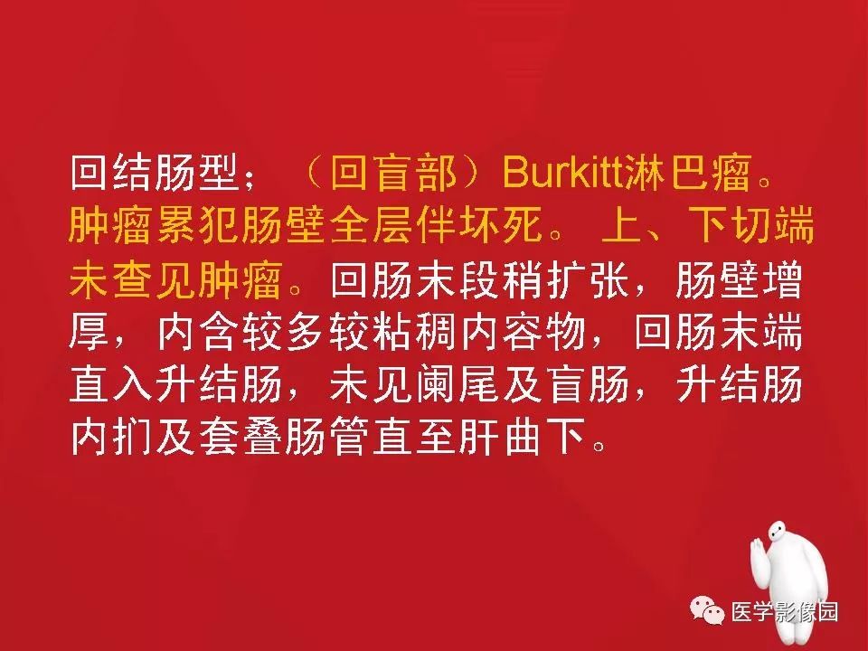 【PPT】肠套叠的CT诊断