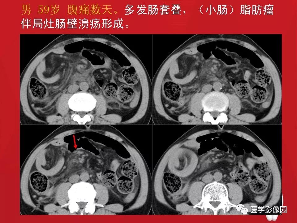 【PPT】肠套叠的CT诊断