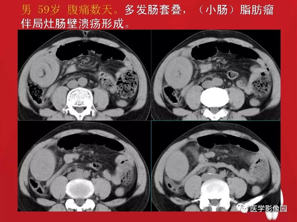 【PPT】肠套叠的CT诊断