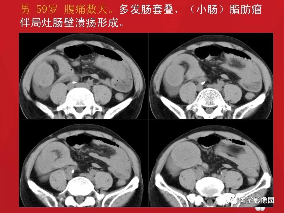 【PPT】肠套叠的CT诊断