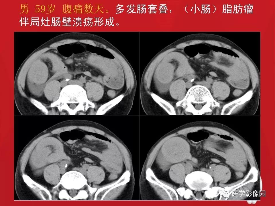 【PPT】肠套叠的CT诊断