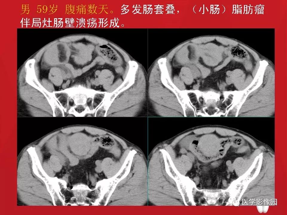 【PPT】肠套叠的CT诊断