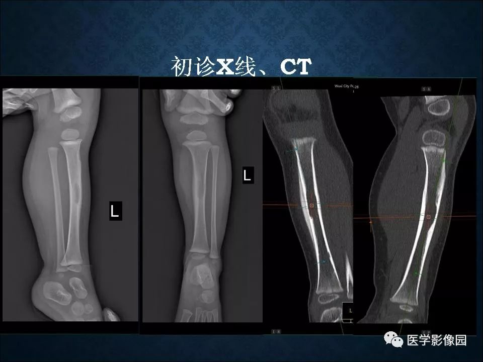 【PPT】长骨嗜酸性肉芽肿影像诊断与鉴别诊断