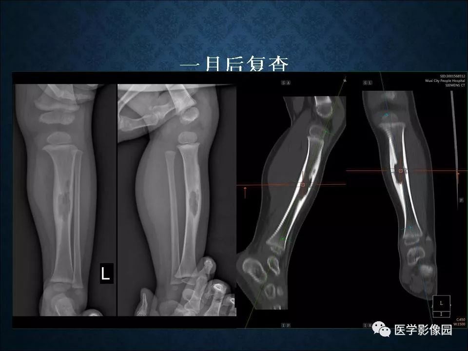 【PPT】长骨嗜酸性肉芽肿影像诊断与鉴别诊断