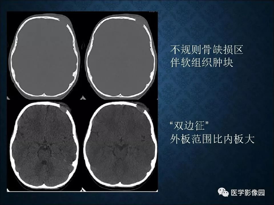 【PPT】长骨嗜酸性肉芽肿影像诊断与鉴别诊断