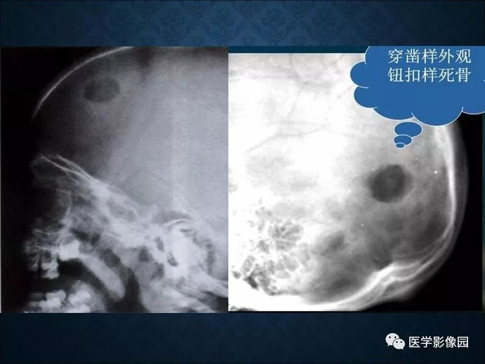【PPT】长骨嗜酸性肉芽肿影像诊断与鉴别诊断