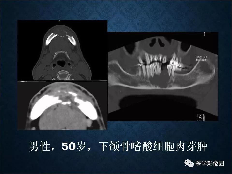 【PPT】长骨嗜酸性肉芽肿影像诊断与鉴别诊断