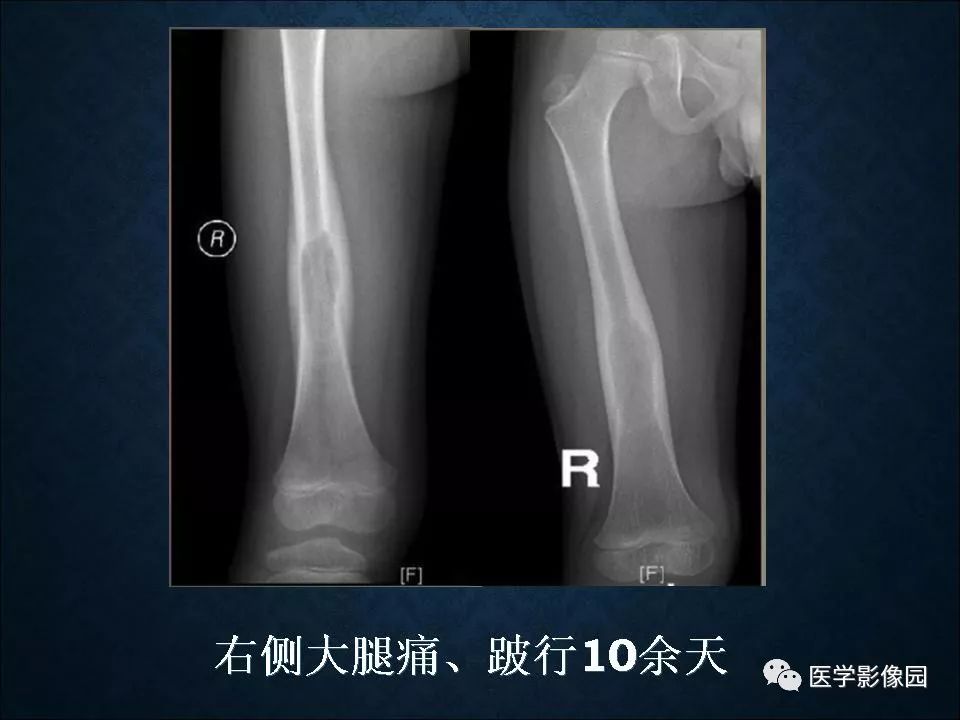 【PPT】长骨嗜酸性肉芽肿影像诊断与鉴别诊断