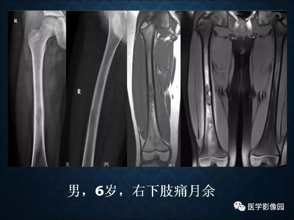 【PPT】长骨嗜酸性肉芽肿影像诊断与鉴别诊断