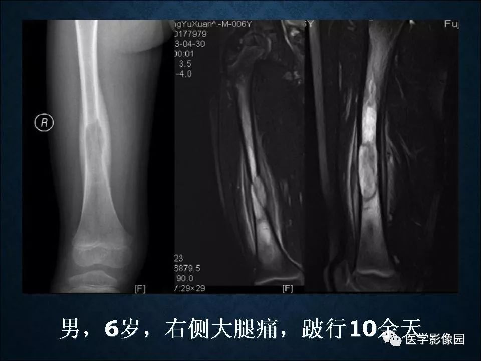 【PPT】长骨嗜酸性肉芽肿影像诊断与鉴别诊断